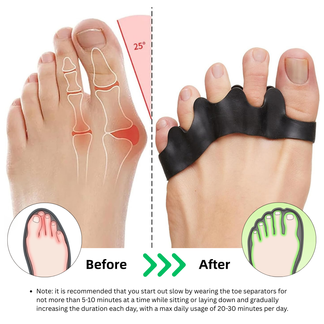 Toe Spacers | Bunion & Foot Pain Relief Splint