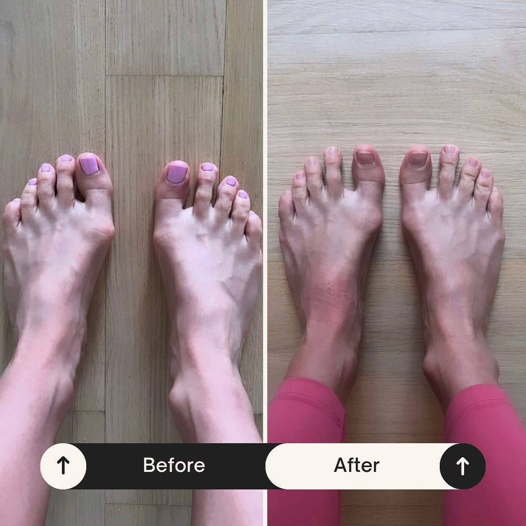 Toe Spacer Socks | The Natural Toe Realignment Solution